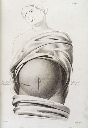 Diagram showing incisions performed in caesarean operation Wellcome L0038227.jpg